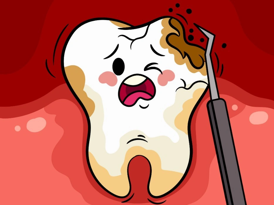 Penyebab Sisa Akar Gigi Tertinggal