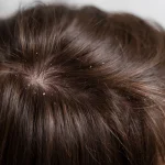 Tak Perlu Produk Mahal, Ini 4 Cara Menghilangkan Ketombe Secara Alami